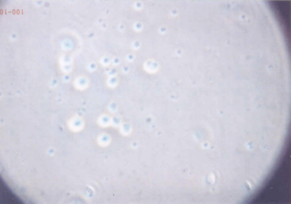 Blood sample 40x Phase contrast - possible Rheumatism